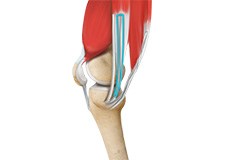 ACL Reconstruction Procedure with Hamstring Tendon