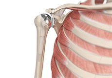 Shoulder Joint Replacement